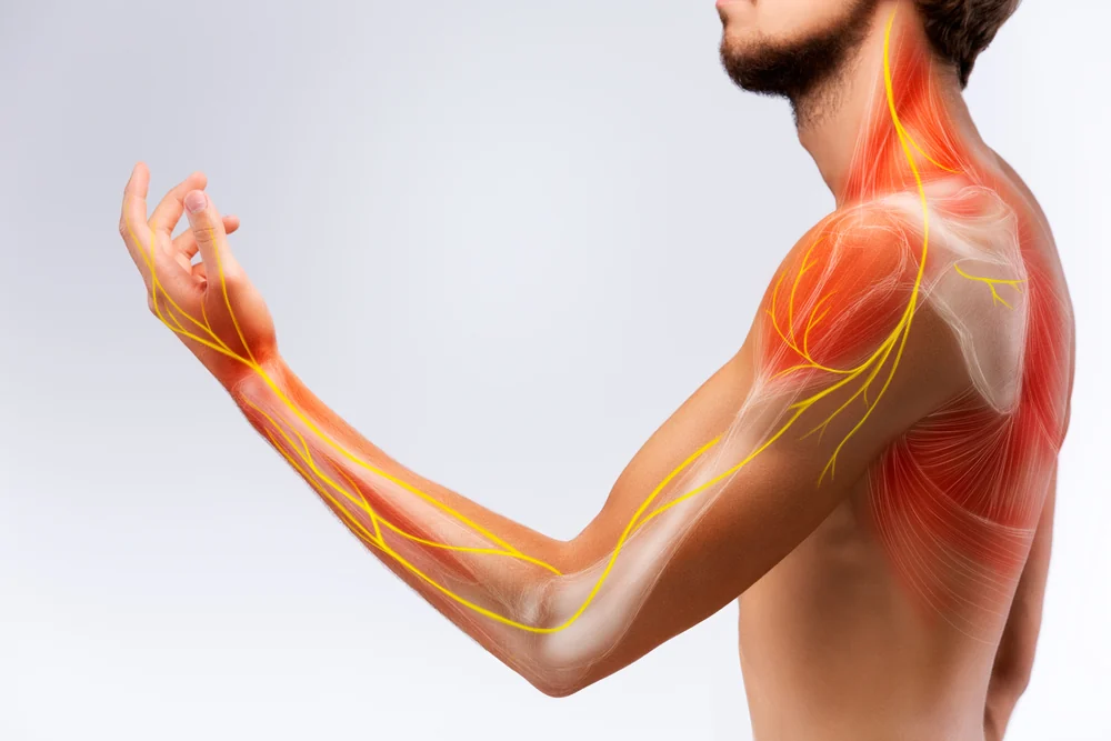 Neck pain spreading to the arm
